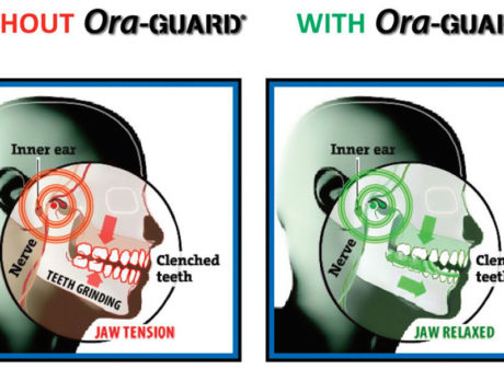 New Nighttime Grind Guard Relieves Jaw Pain