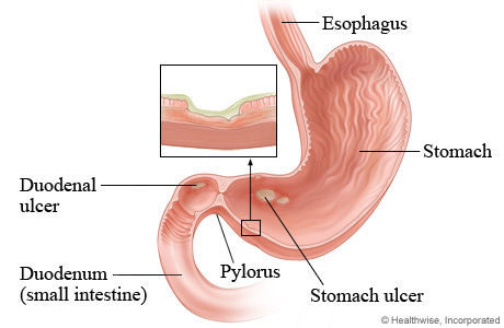Acid-loving bacteria pegged as main cause of ulcers